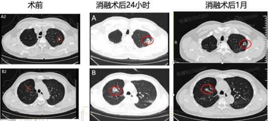 财新网 全球首例！浙大邵逸夫医院用AI机器人“一站式”精准歼灭双肺高危病灶